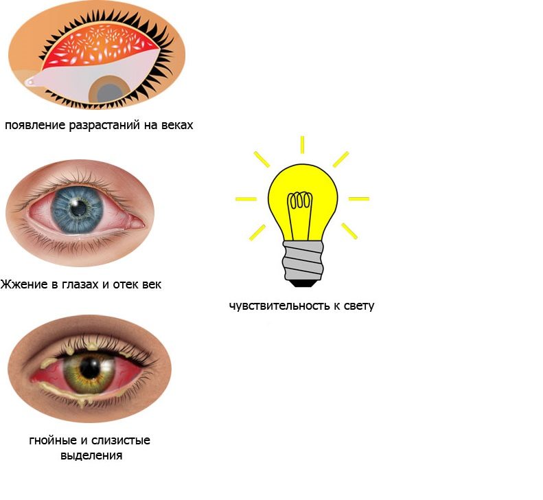 Симптомы конъюнктивита глаз