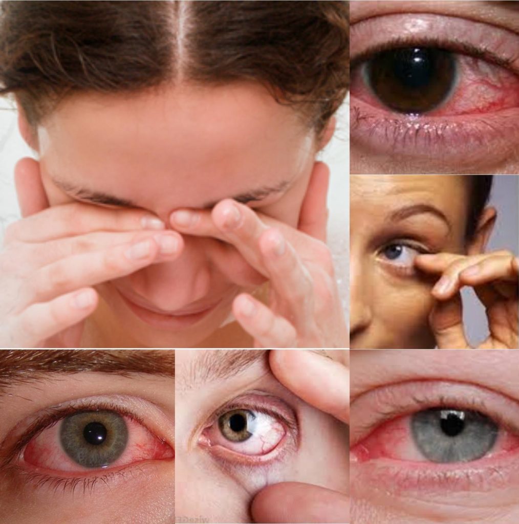 Cиндром сухого глаза или ксерофтальмия