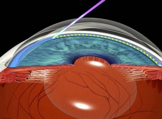Лазерное лечение первичной глаукомы