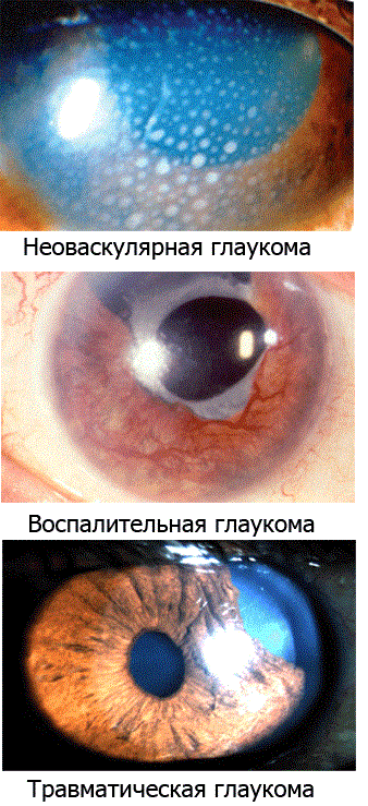 Вторичная глаукома.