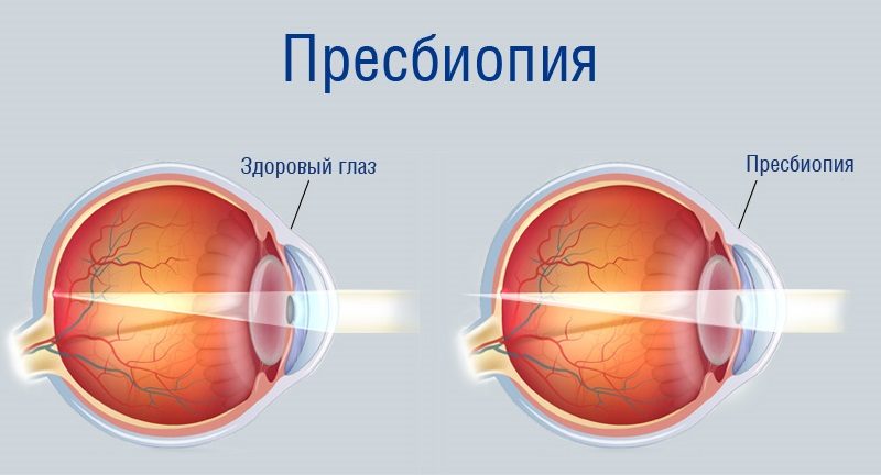 Пресбиопия глаза 