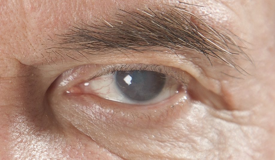 Старческая или возрастная катаракта