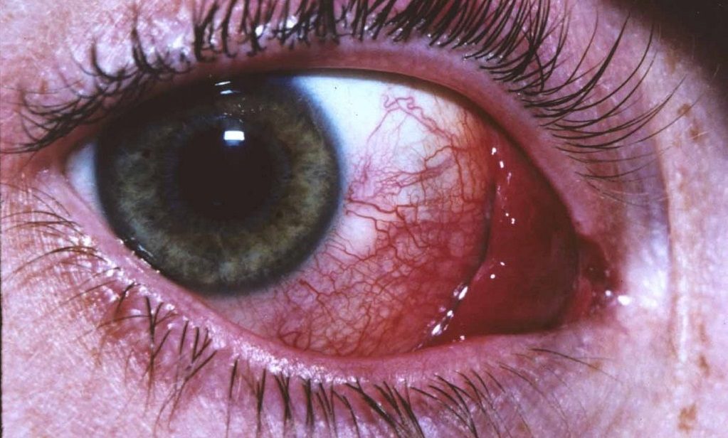 Электроофтальмия глаз