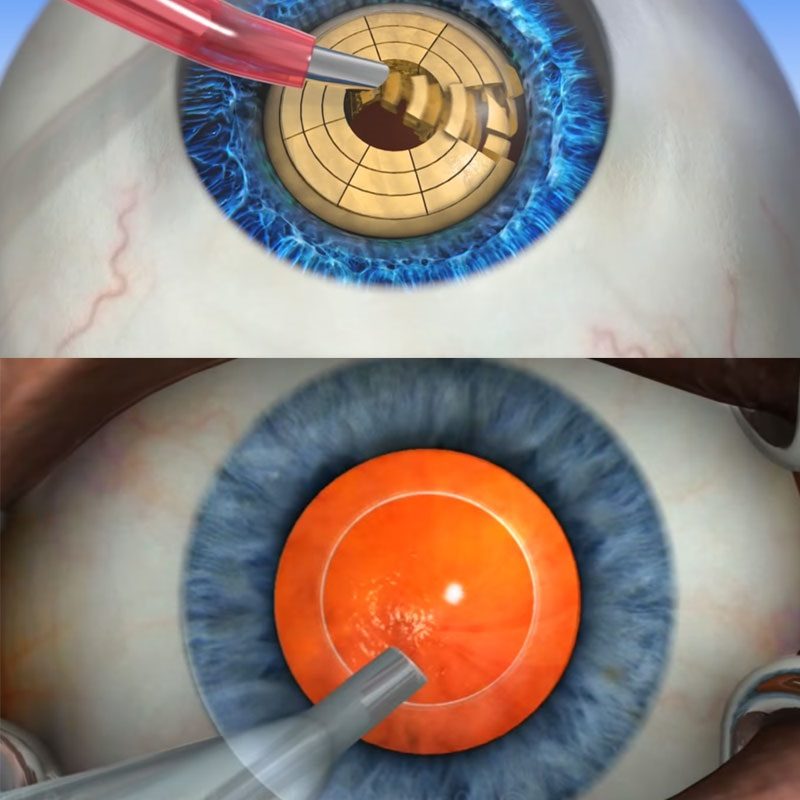 Факоэмульсификация-хирургическое лечение катаракты