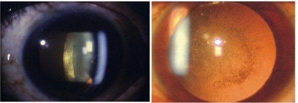  Передняя или задняя субкапсулярная катаракта