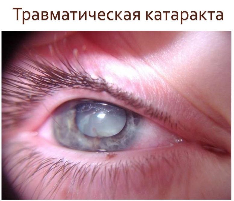 Травматическая катаракта