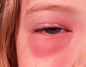 симптомы розацеа глаз