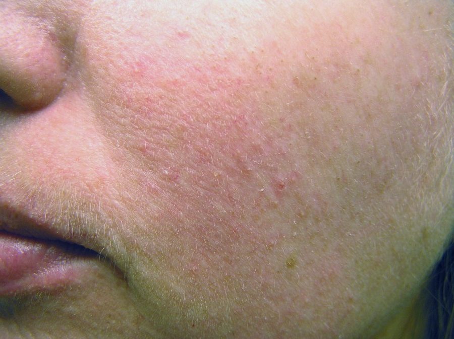 Cимптомы розацеа на лице