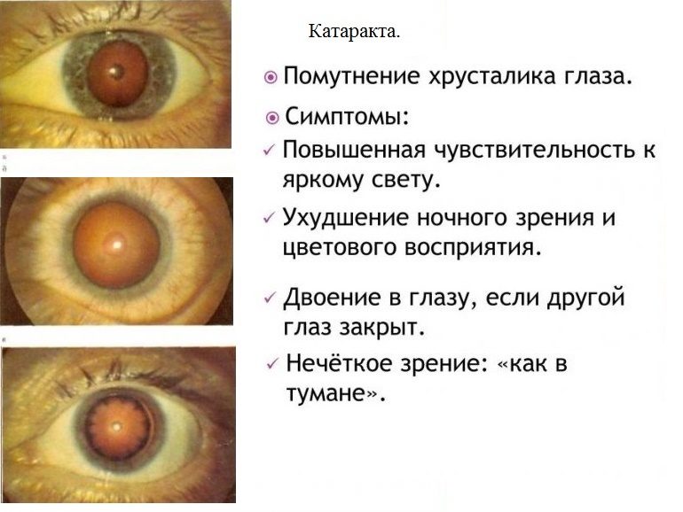 Cимптомы катаракты глаза