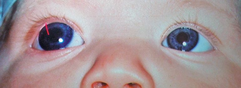 Врожденная глаукома