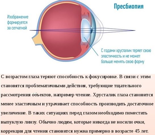 Когда после замены хрусталика восстанавливается зрение глаза. Пресбиопия этиология. Пресбиопия (возрастная дальнозоркость). Старческая дальнозоркость (что это такое? Методы коррекции). Механизм аккомодации пресбиопия.