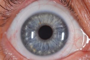 Эндотелиальная микроскопия роговицы глаза